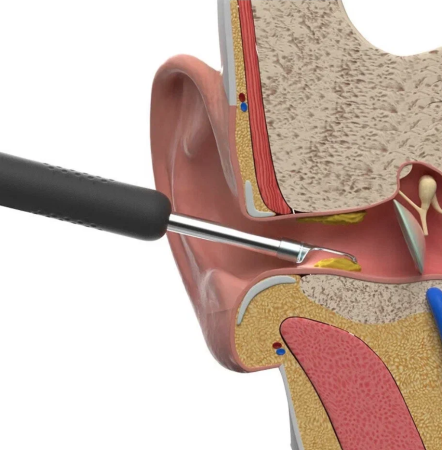 Умная ушная палочка Xiaomi Bebird Smart Visual Spoon Ear Stick R1, Black